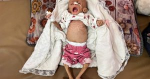 gaza-infant-malnutrition-starvation.jpg